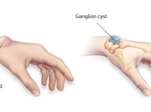 ganglion-cyst