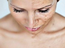 melasma