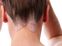 psoriasis