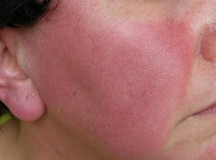 rosacea