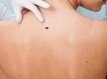 skin-cancer-surgery