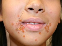 impetigo-skin