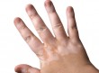 vitiligo