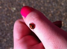 dermatitis-herpetiformis-duhrings-disease